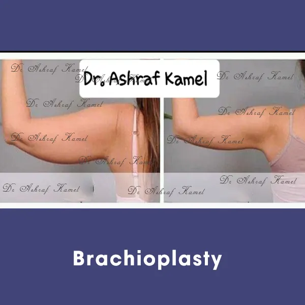 Brachioplasty