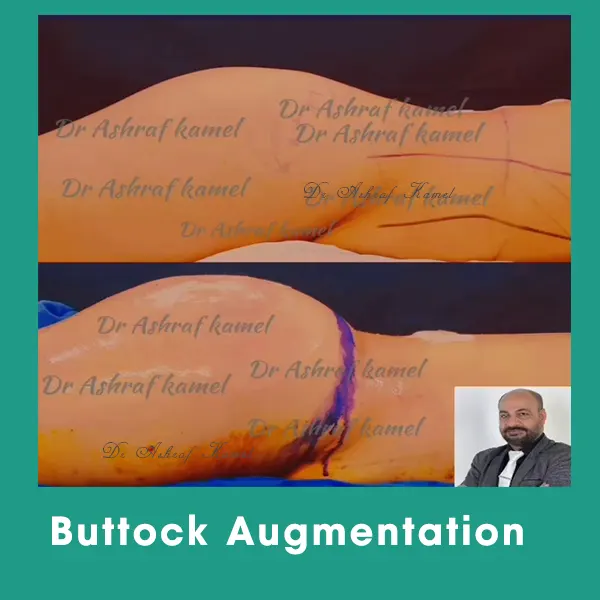 Buttock Augmentation