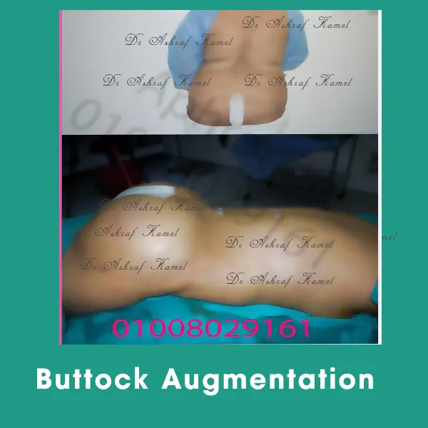 Buttock Augmentation