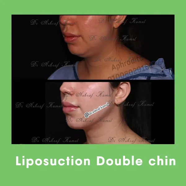 Liposuction Double Chin