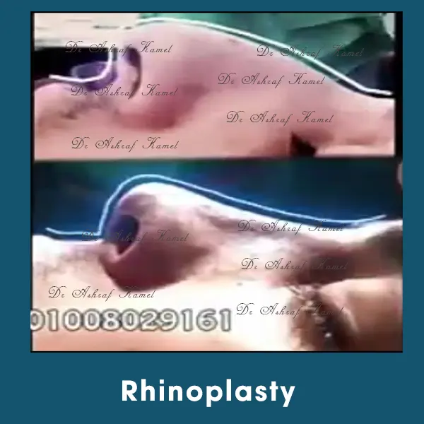 Rhinoplasty
