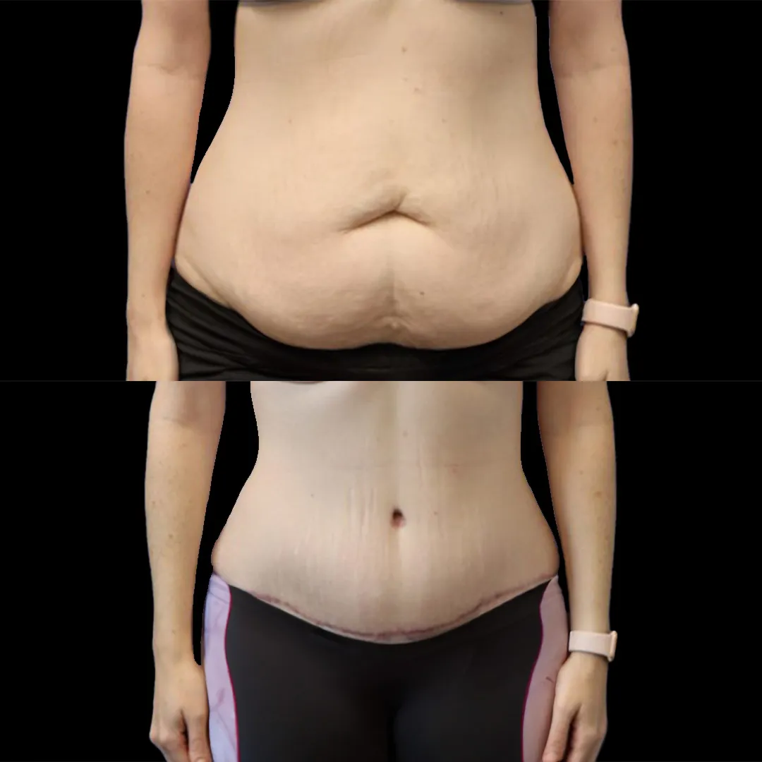 شد ترهلات البطن