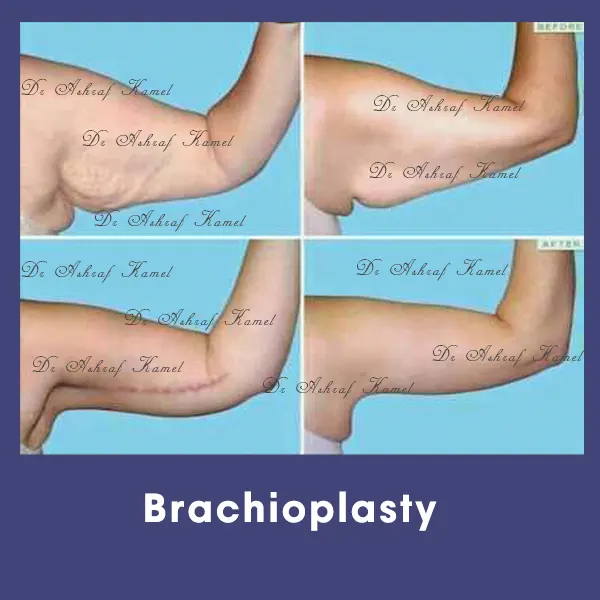 شد الذراعين