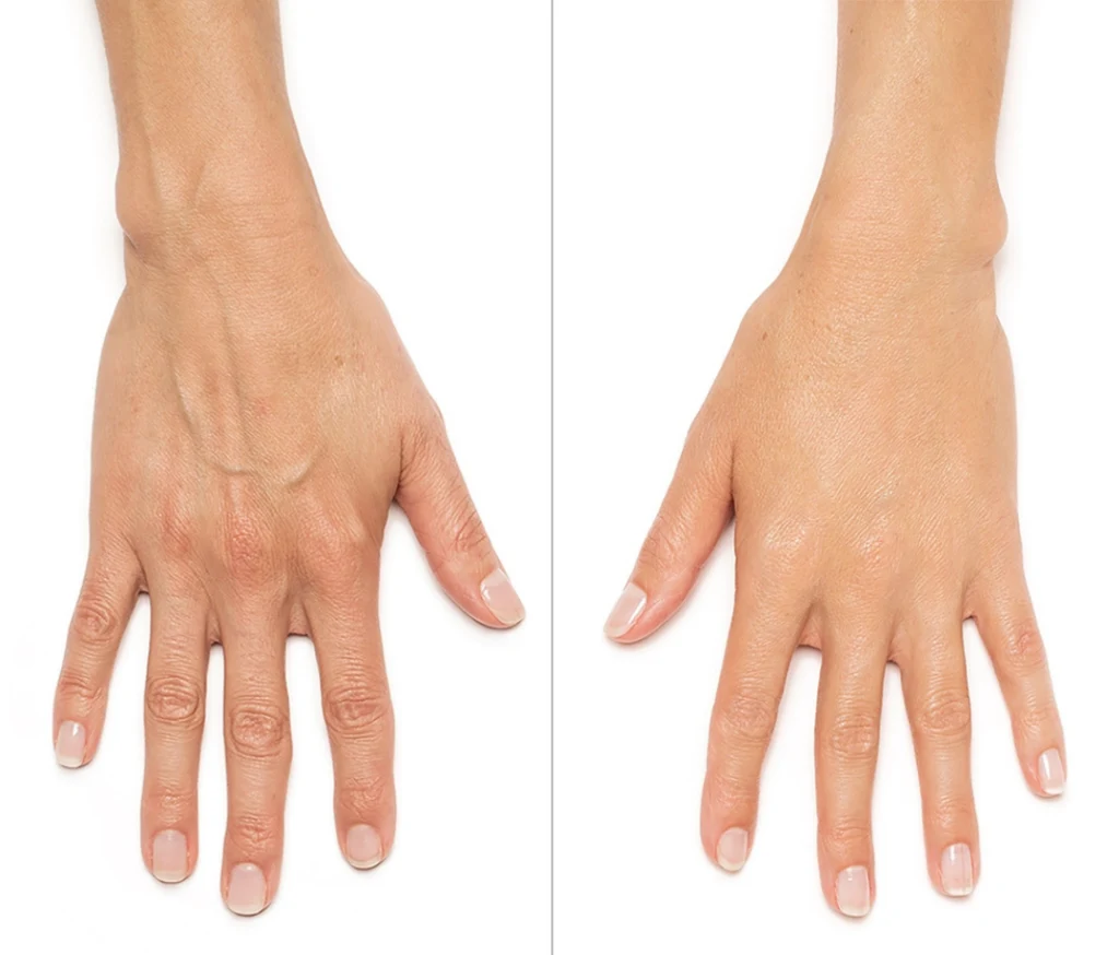 حقن ظهر اليدين