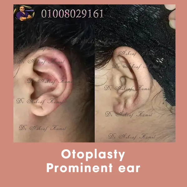 تجميل الأذن