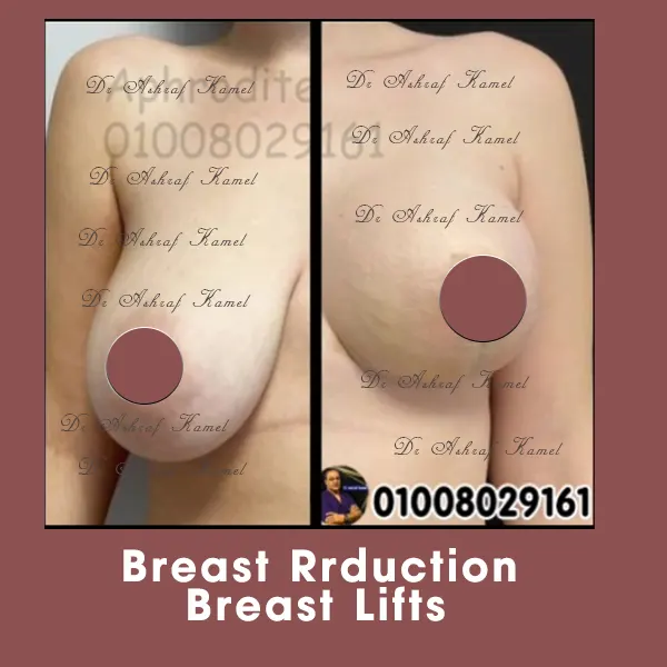 تصغير ورفع الثدي